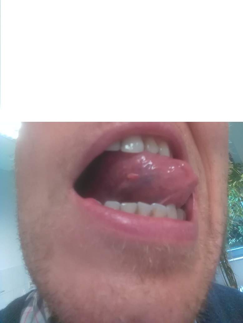 Weißes Bläschen unter Zunge, was könnte das sein? (Entzündung)